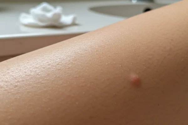 Hair Removal: 5 Myths Making Redness Worse in 2026